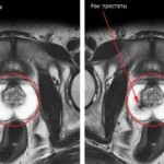 магнитно-резонансная томография предстательной железы