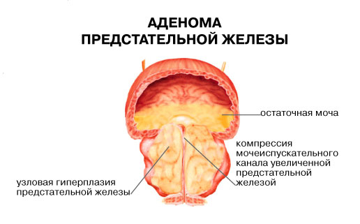 Симптомы аденомы предстательной железы