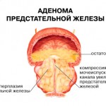 Аденоматозная гиперплазия. Симптомы и лечение