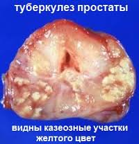 Туберкулез предстательной железы